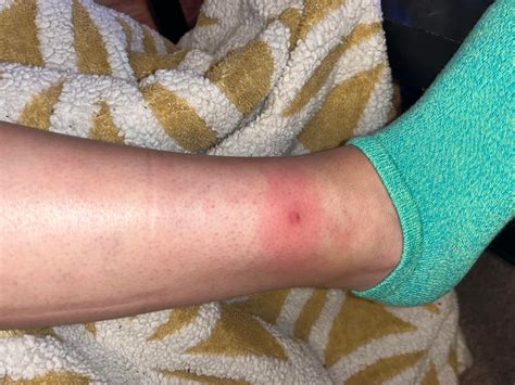 Is this a brown recluse spider/bite? About 24 hours after I noticed