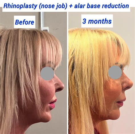 Alar Base Reduction (Nostril Reduction) - Harley Clinic