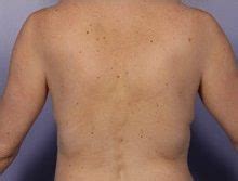 Back Fat, Lower Back Fat, Fat Freezing Back Fat Treatment in London and ...