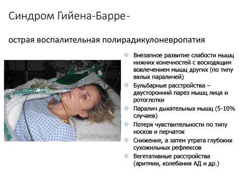 Синдром Гийена-Барре признаки, причины, симптомы и лечение
