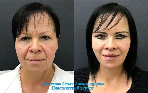 Эндоскопическая подтяжка бровей в Москве