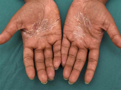 atopic dermatitis hands treatment
