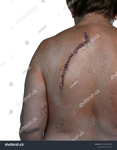 Scar After Spinal Hernia Surgery Stock Photo 2536470887 | Shutterstock