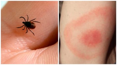 Tick Bite Pictures Symptoms What Does A Tick Bite Look Like? | lupon.gov.ph