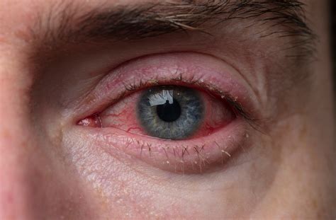 Can Optometrists Treat Eye Infections? | Eye Care Plus