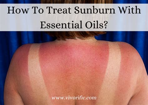 How To Treat Sunburn With Essential Oils