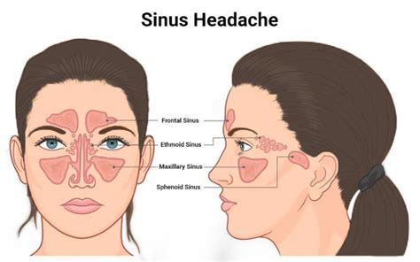 Sinus Headaches - Symptoms, Causes, and Treatment - Advanced Headache ...