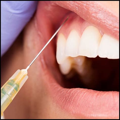 Dental Anesthesia Injection Sites - EsHealthTips