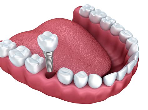 Understanding Dental Implants | Jenson Dental