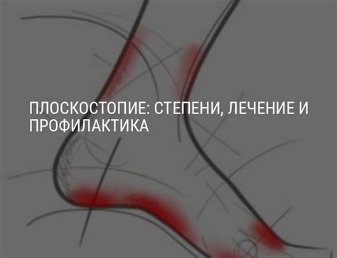 Плоскостопие: степени, лечение плоскостопия и профилактика ...