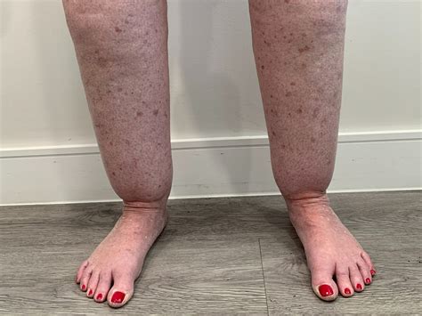 how to know if you have lipoedema