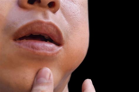 white line inside cheek 4