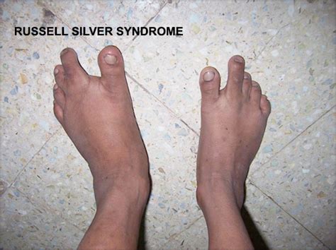 Diagnosis of Russell Silver Syndrome Archives | Dr. Vikram Chauhan's Blog