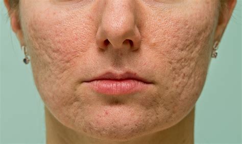 10 Common Bumps on the Face | Stay At Home Mum
