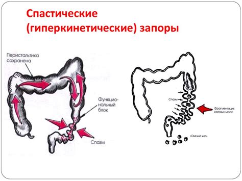 Спастический запор – что это такое, симптомы и лечение у взрослых, детей