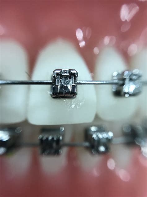 silver teeth braces   uihere