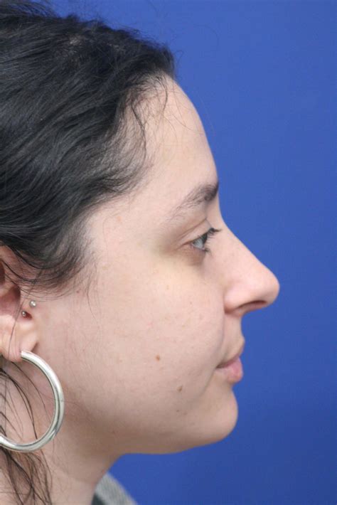 Neck Surgery (Liposuction) - Synergi Facial Surgery