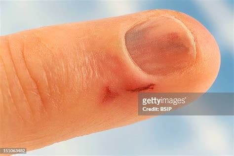 Open Wound Skin Photos and Premium High Res Pictures - Getty Images