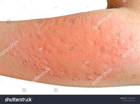 Skin Rashes Allergies Contact Dermatitis Allergic ภาพสต็อก 1710629428 | Shutterstock