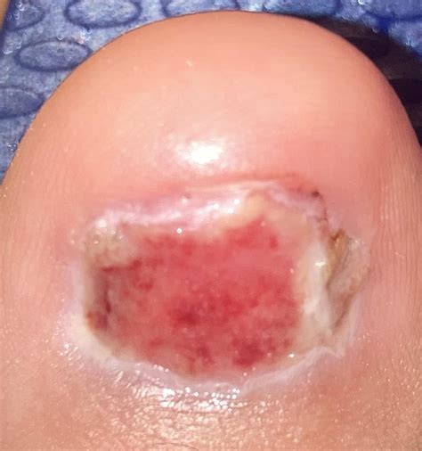 So I just had my toenail removal for the 2nd time and my Dr recommended