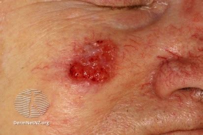 Squamous Cell Carcinoma: Symptoms and Treatment | The Dermatology ...