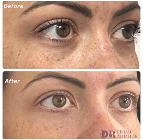 Polynucleotide Treatment Under Eyes | Dr Reham