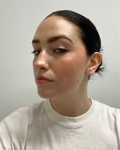 hyaluronic acid fillers benefits drawbacks cost     wear