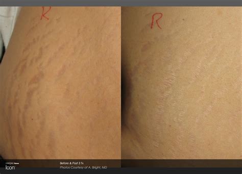 stretch mark removal treatment  sydney bella pelle cc