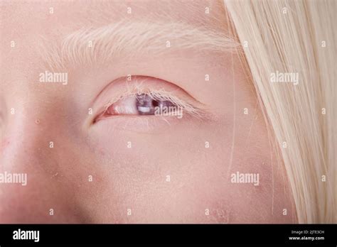 Close-up of young face of albino girl with blue eyes and white ...