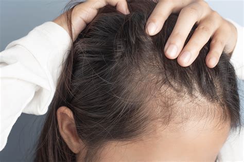 Postpartum Hair Loss: Is Post-Pregnancy Hair Loss Common?