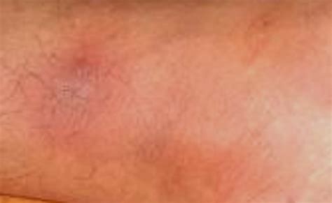 Erythema Nodosum – Pictures, Symptoms, Causes, Treatment | hubpages