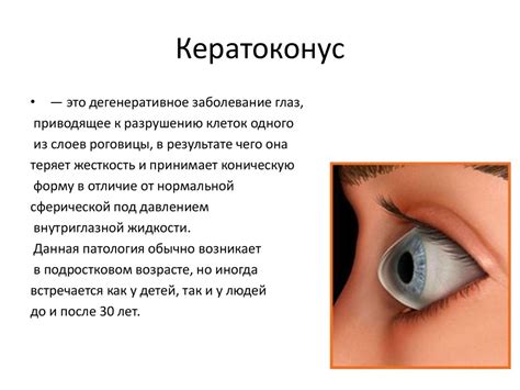 Кераринг. Кросс-линкинг. Кератоконус - презентация онлайн