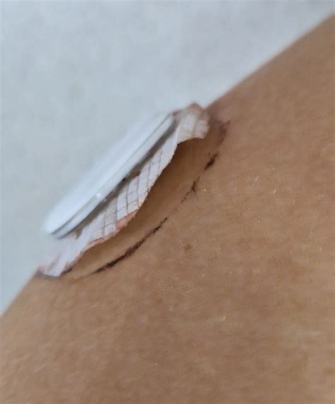 Simplera CGM sensor Medtronic - BAJKcukrzycOWO