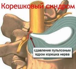 Корешковый синдром, лечение корешкового синдрома при остеохондрозе ...