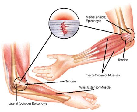 Elbow Pain Treatment in NYC | Elbow Pain Doctors Specialists New York