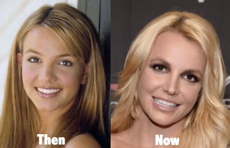 Britney Spears Plastic Surgery Before and After Photos