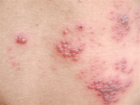 Understanding and Treating Shingles: Advice from a Dermatologist – Archyde