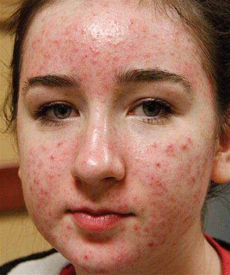 [DIAGRAM] Diagram Of Acne - MYDIAGRAM.ONLINE