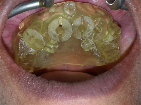 Intaglio surface dentistry - Aslojc