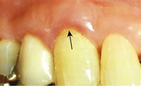 Test 2 Gingival Description Flashcards | Quizlet