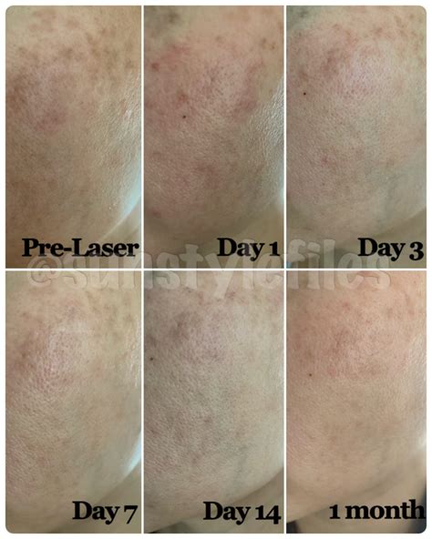 levisa lazer: Before & After Photos That Will Amaze You - r6zjy30