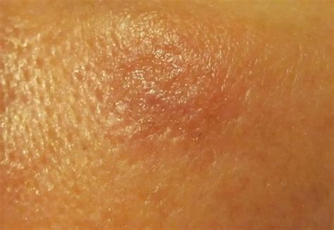 cancer   caecum symptoms  stages cancer