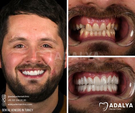 Turkey Teeth Veneers Before and After | Adalya Dental Clinic