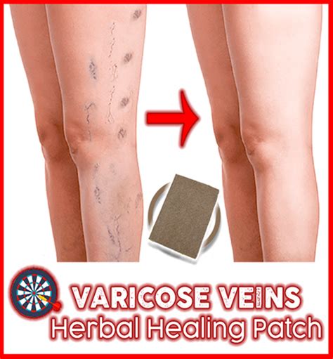 Varicose Veins Herbal Healing Patch - Not sold in stores