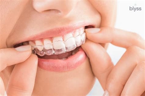 Invisalign Process: The Whole Treatment Procedure Explained