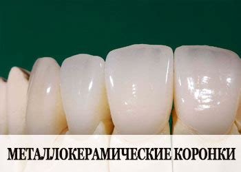 Металлокерамика на Передние Зубы (Цена Установки от 9300р)