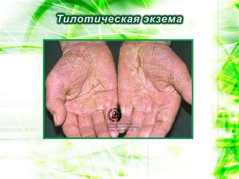 Экзема - презентация онлайн