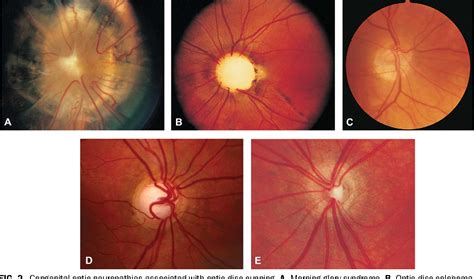 Figure 1 from Optic Nerve Cupping and the Neuro-Ophthalmologist ...