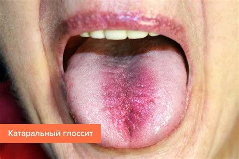 Glossitis: types, symptoms and treatment – Healthy Food Near Me