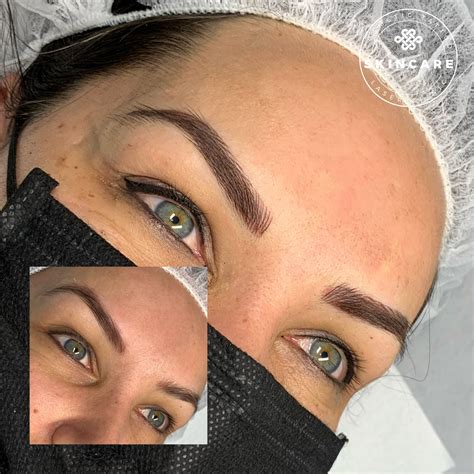 laser tattoo eyebrows 5